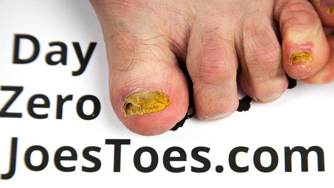 Day zero left foot alt text